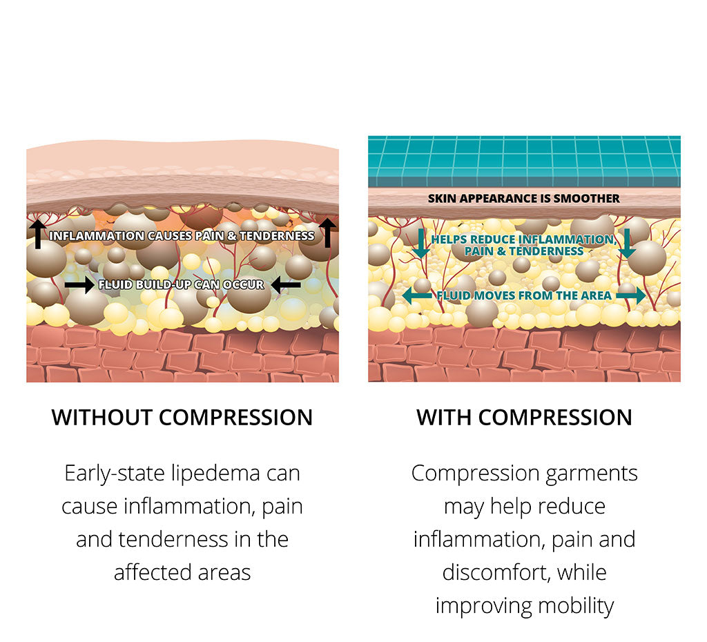 Lipoedema - Compression - Indications & treatment