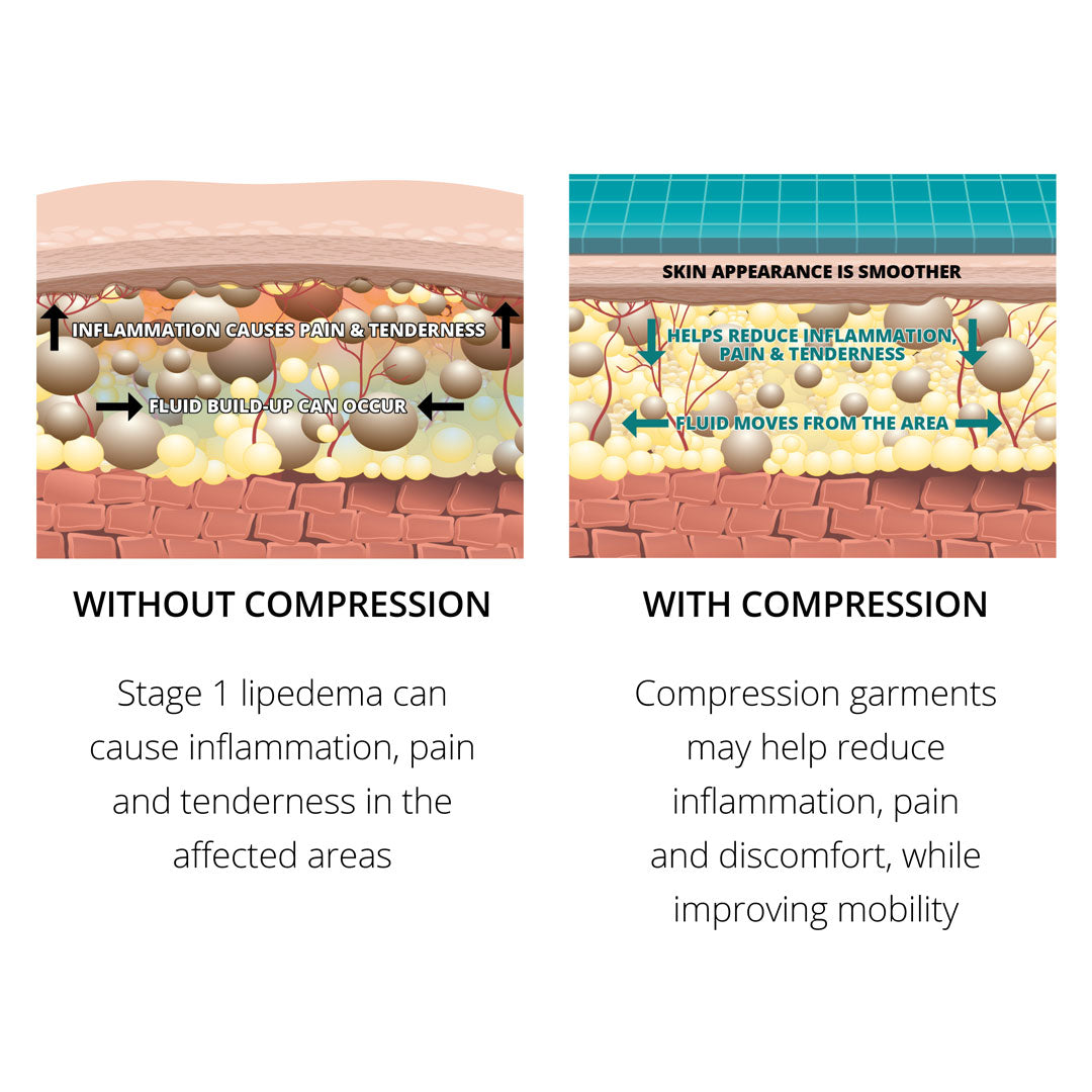 Lipedema Compression Garments - The Marena Group, LLC