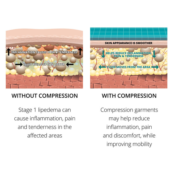 Lipedema Compression Garments - The Marena Group, LLC